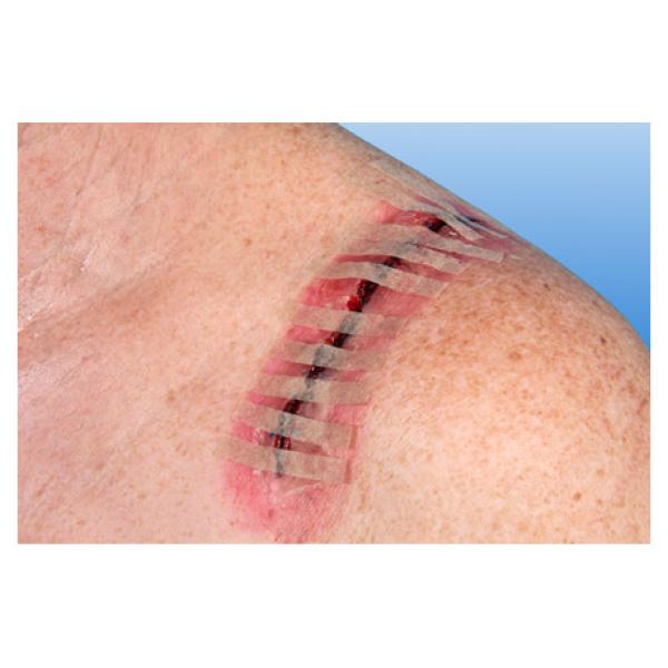 Preview: Rudanaht, steril - Wundnahtstreifen, hautfarben (SSB-fähig)