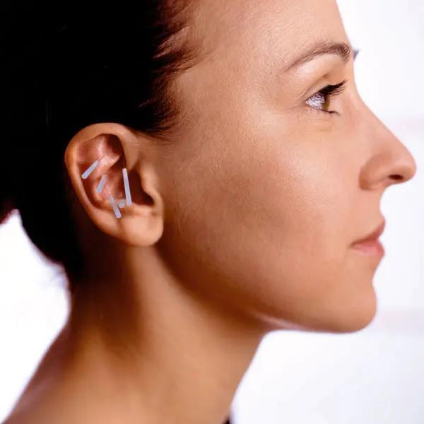 Preview: SEIRIN Akupunkturnadeln Typ B