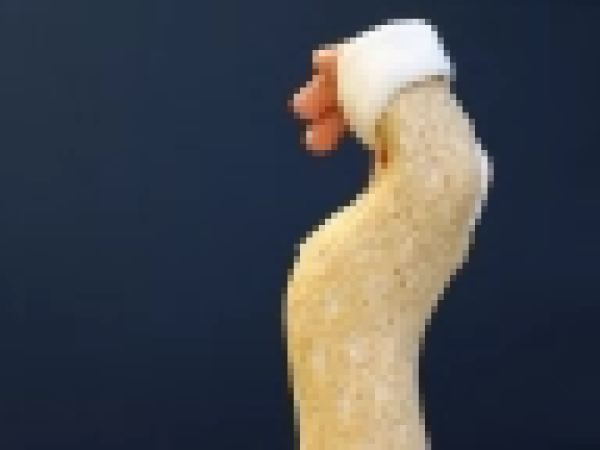 Preview: Woodcast Splint 4 mm - Stabile Frakturversorgung, ideal für Kinder - da hohe Belastbarkeit (SSB-fähig)