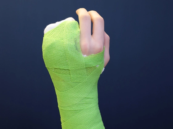 Woodcast Splint 4 mm - Stabile Frakturversorgung, ideal für Kinder - da hohe Belastbarkeit (SSB-fähig)