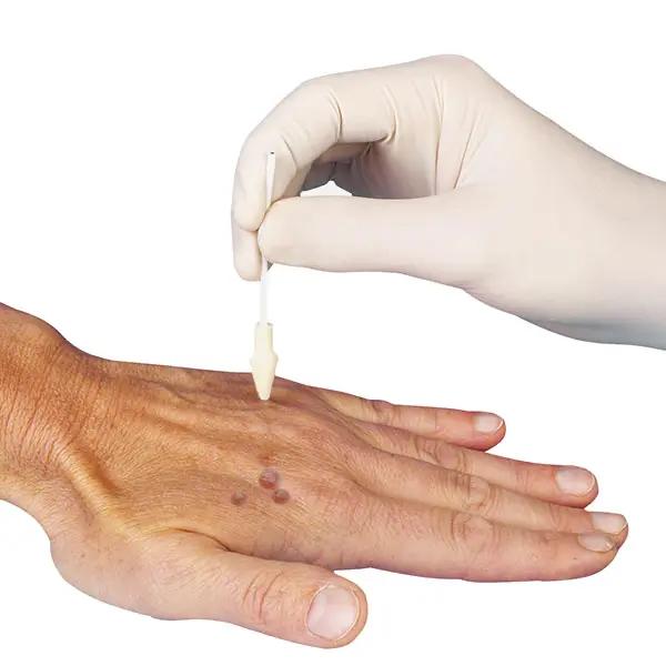 Dermafreezer Ersatztips - Kryotherapie zur Warzenentfernung